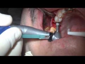 Immediate Placement MIS SEVEN Implants – Live Surgery
