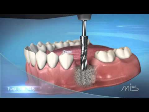 MIS M4 Implant Procedure Video
