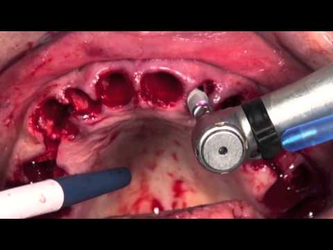 Teeth in a Day with MIS V3 Implants