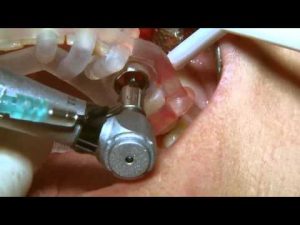 MGUIDE Live Surgical Video with Dr. Alon Schifter